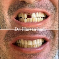 تعويض الأسنان المفقودة بأحدث الطرق العلاجية نتيجة طبيعية وابتسامة أجمل...