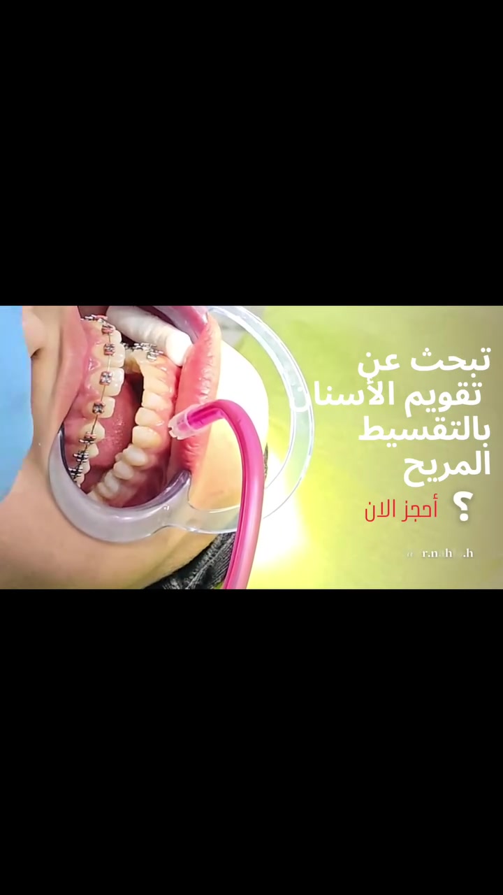 للاستفسار ***********
#تقويم_الاسنان
#تجميل_الاسنان 
#العراق
