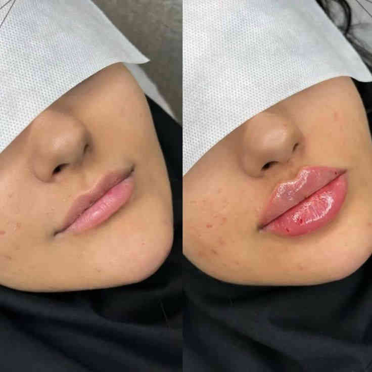 سوينه عروض 
✨تردين تسوين  تجميل ما عندج يمنه سعار مناسبا
عروض راس اسنه عروض جميلههه
*ابلازمه وجه 30💃🏻💃🏻
*ابلازمه وجه لتصبقات والكلف 40🔥🔥
*فلر شفه كوري ب30💋
*فلر شفه الفرنسي  ب35🔥💋
*فلر شفه باريسي ب50💋💃🏻
*فلر شفه اسويسري ب55💋🫂
*فلر وجنات  سيسي 35 (6جلسات)🙎🏻‍♀️
*نضاره الفائقه 45*
*ابرة العنبر الزعفرانيه ب40

*بوتوكس لرفع الحاجب  ب50🤎
*بوتوكس شد كصه ب50💆🏻‍♀️
*بوتوكس لتوسيع العين ب50🫣
*بوتوكس لشد التجاعيد 110🫢
*غمازه 25🔥🔥🔥
*تبييض البشرة ب70 ألف 💋💃🏻
*ابرة نضارة وتوريد وترطيب ب100الف 🔥🔥🔥
*علاج الگلف العميق 60 ألف 
*تعديل الأنف بل فلر ب45
*علاج داء الوردية ب30 ألف🔥🔥🔥🔥
*تغيرر شامل فلر فرنسي ايطالي 300
العنوان//كربلاء 
الستفسار /***********
