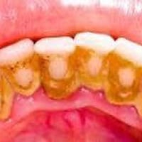 تنظيف اسنان • ازالة التكلسات • كلية طب اسنان بابل