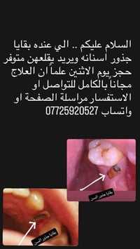 مجاناً .. السلام عليكم الي عنده بقايا جذور ويريد يقلعهن متوفر حجز على ...