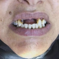 مختبر أسنان • زيركون سيراميك • سوق الخالص