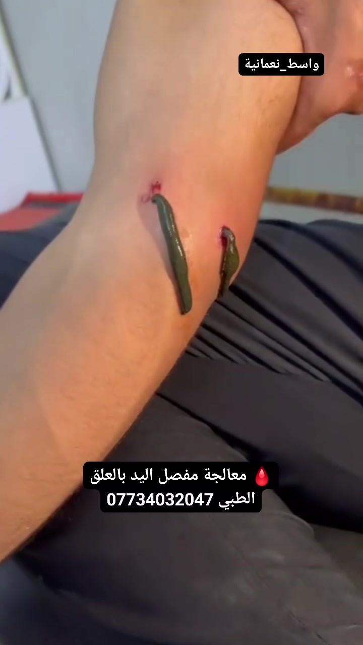🩸 معالجة مفصل اليد بالعلق الطبي

تُستخدم المعالجة بالعلق الطبي في بعض حالات آلام ومشاكل مفصل اليد، وقد تساعد على:
✅ تحسين الدورة الدموية حول المفصل.
✅ المساعدة في تقليل الاحتقان والتورم.
✅ المساهمة في تخفيف الألم لدى بعض الأشخاص.
✅ دعم حركة المفصل وتقليل الشعور بالتيبس.
✅ المساعدة في تحسين وصول الدم إلى الأنسجة المحيطة بالمفصل.

📍 العنوان: محافظة واسط – قضاء النعمانية – شارع 13 – مقابل صيدلية علاء حسين كريم.
👩‍⚕️ يوجد كادر نسائي للنساء وكادر رجالي للرجال.
📞 للحجز والاستفسار: ***********

#العلق_الطبي #مفصل_اليد #آلام_المفاصل #الطب_البديل #النعمانية #واسط
 #الجميع 
 #متابعين 
 #اشارة 
 #الكل 
 #followers  
#everyone
