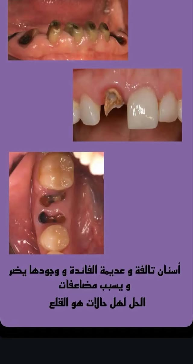 نعلن عن استقبال مراجعين للعلاج مجانــاً بالكامل وبدون أي أجور كشفية، مع استخدام أحدث الأجهزة وبإشراف مباشر من نخبة من أفضل أطباء الأسنان

🔹 خدماتنا تشمل:
✅ فحص شامل + خطة علاجية
✅ الحشوات التجميلية (البيضاء)
✅ تنظيف الأسنان + إزالة الكلس والجير
✅ القلع البسيط 
✅ طقم الاسنان الجزئي (3-6)اسنان

🦷 ونوفر لكم أفضل المواد العالمية:
✔️ حشوات تجميلية من Tokuyama – واحدة من أرقى وأقوى الشركات بالعالم
✔️ سمنتات ولاصقات عالية الجودة
✔️ مواد تعقيم آمنة وفعالة

📍 المكان: جامعة االمصطفى - شارع فلسطين
📞 للحجز والاستفسار على الخاص 

⚡️ لا تخلي الفرصة تروح عليك.. عالج اسنانك قبل رمضان🦷✨


**إذا كنت صاحب هذا الإعلان وتريد حذفه لأي سبب، رجاءا أرسل رسالة إلى الدعم الفني**