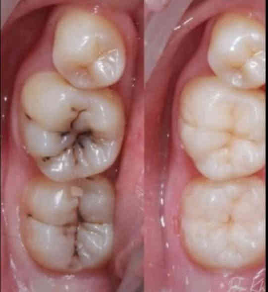 السلام عليكم 
تعاني من ألم ، تسوس ، أو تحتاج تنظيف للأسنان وازالة التكلسات ؟

عيادات جامعة كلكامش تقدّم لك علاج مجاني ويشمل  :

- تنظيف عميق وإزالة التكلسات

- حشوات تجميلية

- قلع الأسنان المتحركة أو الجذور التالفة عند الضرورة

- طقم جزئي متحرك لتعويض الأسنان المفقودة

- تشخيص دقيق وخطة علاج كاملة

✔️ شغل نظيف وآمن
✔️ أدوات معقمة
✔️ متابعة كاملة لحالتك

📍 العنوان: الدورة - حي الصحة - عيادات جامعة كلكامش (مجمع نون والقلم)

للحجز والاستفسار : ***********
راسلوني واتساب او على الخاص  🤍

د. زهراء علاء
