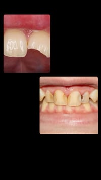 الي اسنانه مثل الصوره ويحتاج حشوات ضوئية خ يتواصل وياي  07883336390