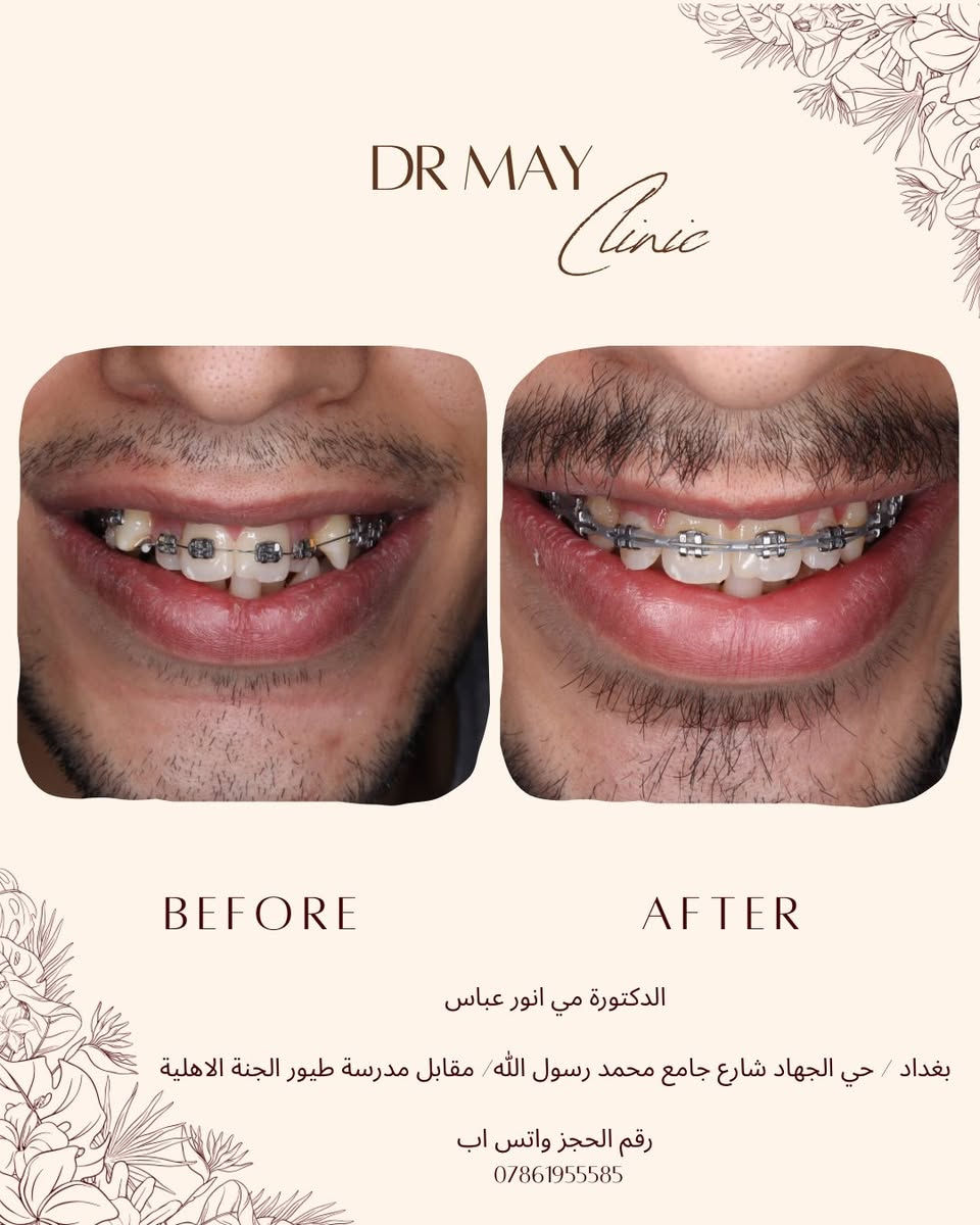 إذا عندك اسنانك مخربطةو متردد تبدي تقويم، نصيحتي لا تأجل الموضوع أكثر.
أهم شي تختار طبيب يشرحلك الحالة بوضوح ويحددلك خطة علاج مناسبة وفوك كل هذا بنظام التقسيط المريح 

الدكتورة مي انور عباس
بكالوريوس طب وجراحة الفم والأسنان / جامعة بغداد
دبلوم بريطاني في تقويم الأسنان

العنوان
حي الجهاد شارع جامع محمد رسول الله مقابل مدرسة طيور الجنة الاهلية 

تكدرون تتواصلون ع واتس اب العيادة لاي استفسار 
***********
