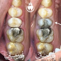 إعادة حشوة جذر • ضاحك علوي • التهاب تحت الجذر