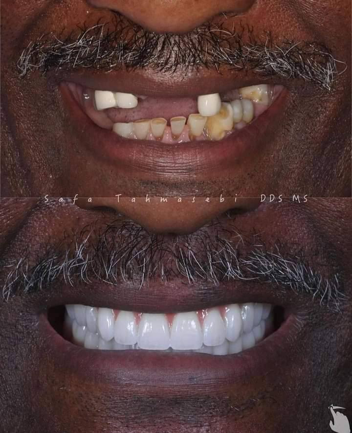 يعلن مختبرات السوري للاسنان 😍🦷🦷🦷🦷🦷🦷
عن تخفيضات تصل 50% عن جميع انواع التغليف السيراميك 🦷الزاركون 🦷الايماكس 😘😘 هووليود سمايل 🦷🦷😍😍مع ضمان مدى الحياه   
بكادر سوري متميز 
للتواصل ***********
واتس اب
