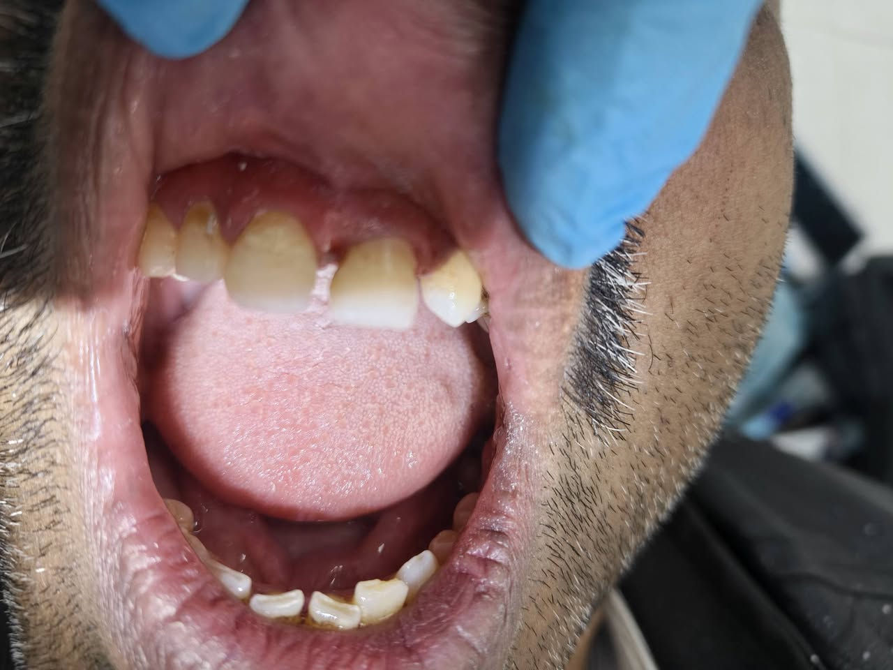 يتوفر علاج اسنان مجاني (حشوات ضوئية، تعويض اسنان مفقودة، قلع بقايا الجذور والاسنان التالفة، وتنظيف الاسنان، وحشوات الجذور)
العلاج يكون  مجاني بالكامل وتحت إشراف اطباء اخصائيين، جامعة البيان شارع مطار بغداد، 
للحجز و الاستفسار التواصل في الخاص او على الواتساب ***********
