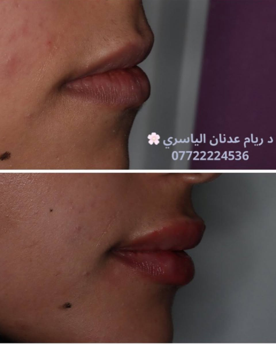 ✨ لأن صحتك وجمالك يستاهلون الأفضل ✨
تقدم لكم عيادة [الضياء سمايل]
أفضل الخدمات الطبية والتجميلية بأحدث الأجهزة وعلى أيدي مختصين 💉🌸
✔️ استشارات طبية دقيقة
✔️ جلسات تجميل وعناية بالأسنان
✔️ نتائج مضمونة واهتمام بأدق التفاصيل
📍 الموقع: [السماوه حي المعلمين مقابل نيكست لفل]
📞 للحجز والاستفسار: [***********]
💖 راحتك وثقتك بين إيدينا 💖

https://www.instagram.com/dr.riyam_alyasiri?igsh=N2xva2FtOHNpNXpi
