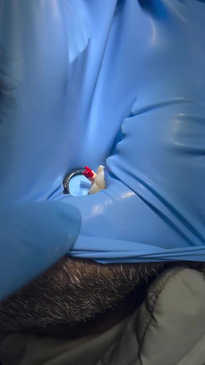 عيادة الطائي لطب الاسنان 🤍

الشغل النظيف والتعقيم الي راح يرضيكم بعلاج حشوات الجذور 🦷 

#سبعالبور #التاجيات #التاجي #سبع_البور #بغداد  

عيادة الطائي لطب الاسنان
 Hussein Al-Saadi
 Mahdi Nafee

للأستفسار : *********** واتس اب فقط
ايضاً على الرقم : ***********
