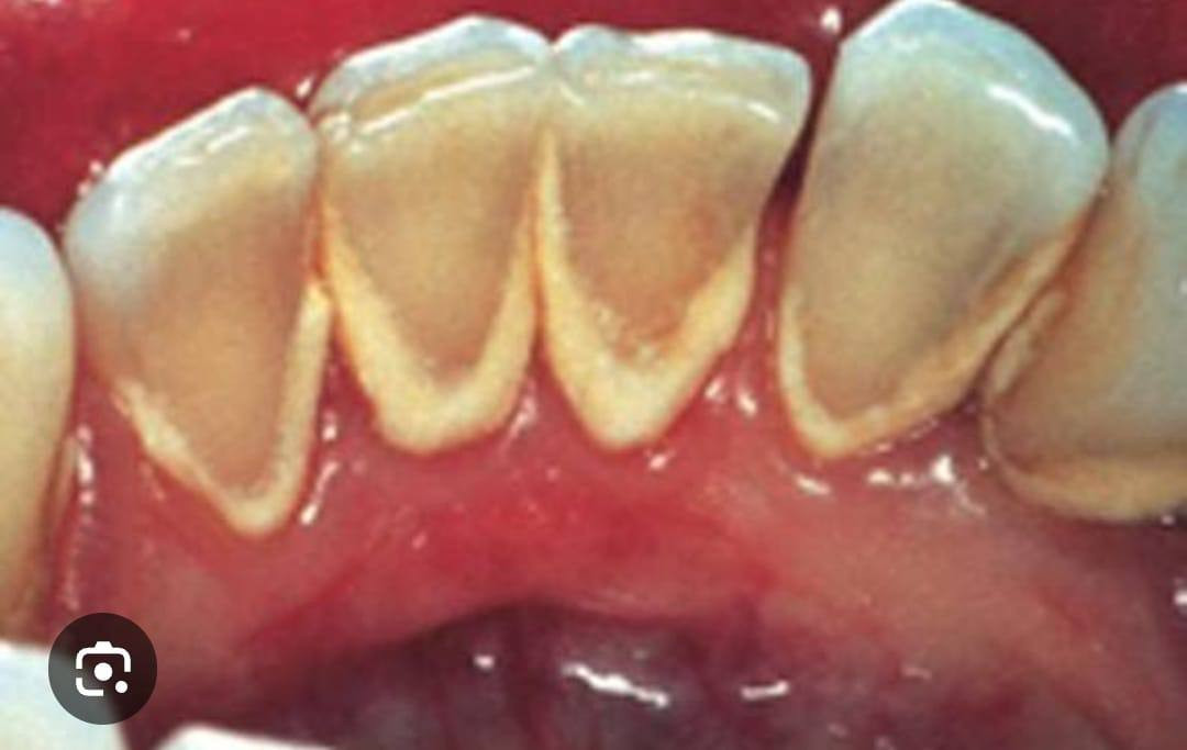 يتوفر علاج مجاني للاسنان في عيادات كلية دجلة في الدورة شارع المصافي يشمل حشوات ضوئية، ازالة التكلسات وتنظيف وتبييض الاسنان، قلع الاسنان والجذور المتبقية وتعويض الاسنان المفقودة باطقم جزئية متحركة
باشراف اطباء مختصين
للتواصل والحجز د. مريم فراس صاحب *********** يتم تعويض تكلفة المواصلات للمراجع عند الحضور
