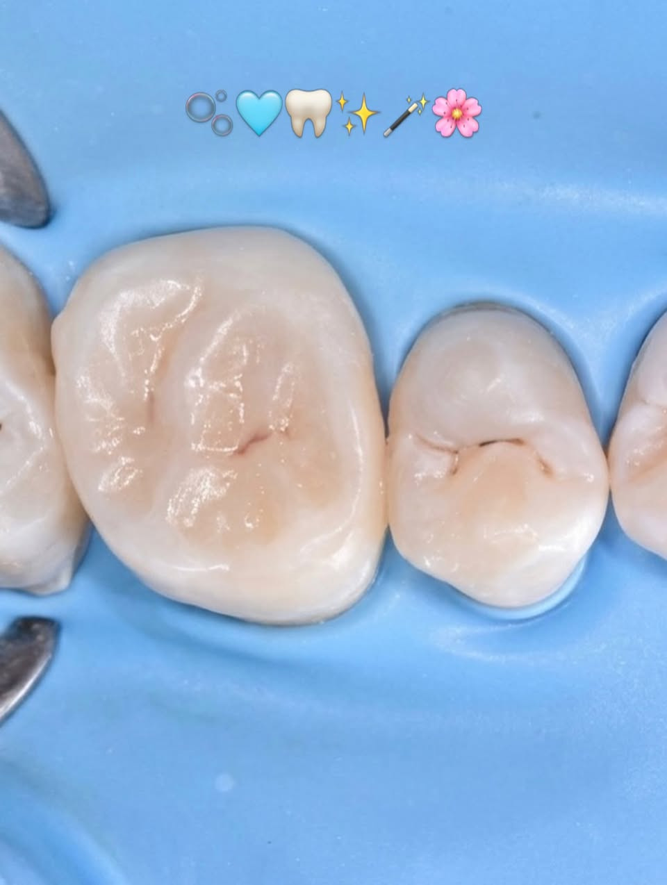 حشوة مختبرية 🦷🪄🫧🌸
.
.
.
.
#حشوة_مختبرية #حشوة_ضوئية #ابتسامتك_أجمل #ابتسامة_طبيعية #صحةالأسنان


**إذا كنت صاحب هذا الإعلان وتريد حذفه لأي سبب، رجاءا أرسل رسالة إلى الدعم الفني**