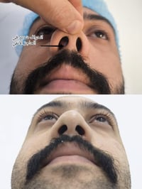 تجميل الأنف • انحراف الحاجز • تخدير موضعي