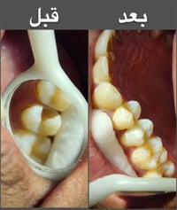حشوات كومبوزيت • تجميل أسنان • خانقين