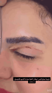 📍 يتواجد الدكتور محمد محمود
🩺 أخصائي جراحة التجميل

⏰ كل يوم من الساعة 2 ظهرًا حتى الساعة 10 مساءً

🏥 في مجمع الدر الطبي
📌 العنوان: بسماية – الشارع العام – بالقرب من سوبر چكن – فوق حلويات قشطوطة

📱 للاستفسار عبر واتساب: ***********
