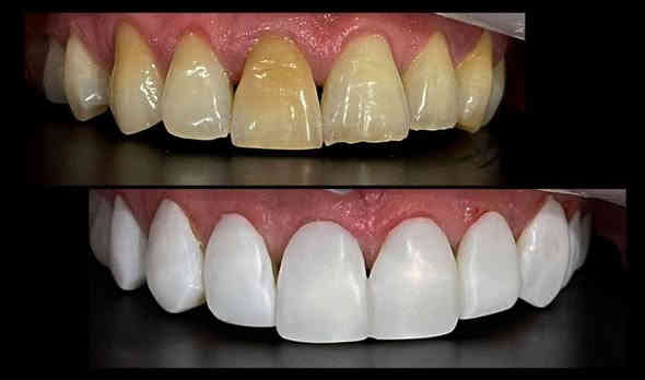 تعلن عيادة إبرو لطب الأسنان وتجميل عن عروض وتخفيضات في قسم الأسنان وتجميل مكان العياده ماجديه نهاية شارع الجامع مقابيل مأكولات البيك ويوجد ايضا ليزر لإزالة الشعر والوشم رقم الحجز ***********
