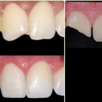 منو عنده هيج سن مكسور ويحب نرجعه مثل صوره يتواصل وياي والعمل كله مجاني...