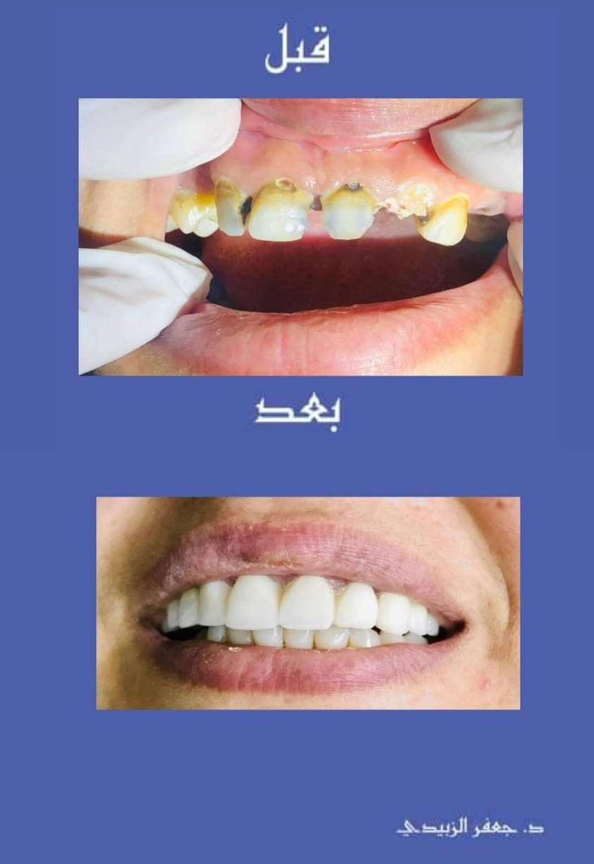 #تحيه_طيبه
سوف يتم بأذن الله التواجد في مجمع الشفاء الطبي الدبوني 
الدكتور جعفر حبيب الزبيدي
اختصاص طب وجراحة الفم والاسنان 
قلع-حشوات جذور-تقويم اسنان-تنظيف تبييض-تعويض الاسنان المفقود
#السبت_الاثنين_ليلآ
#الاربعاء_الخميس_الجمعة_عصرآ 
#الدبوني_خلف_صيدليه_زهراءمهدي
#في_مجمع_الشفاءالطبي_الدبوني
الاستفسار ***********
