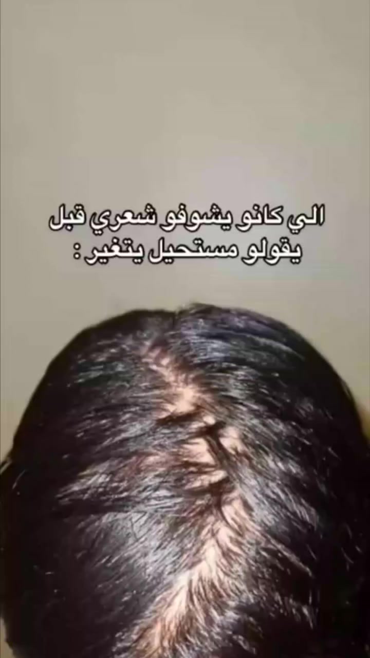 شعرچ تعبان، يتساقط وميتحرك طوله؟ 🤦‍♀️💔
​بدل الخلطات والحلول المؤقتة، رجع توفر المنقذ الأفغاني الأصلي 💯! البكج الثلاثي اللي يحل كل عقدة بشعرچ بمنتج واحد طبيعي 100%.
​ليش لازم تستخدمين الزيت الأفغاني؟
✅ يوقف التساقط من أول أسبوع.
✅ يثخن ويطول الشعر بشكل ملحوظ (يملي الفراغات).
✅ يعالج التقصف والجفاف الناتج عن الصبغ والحرارة.
✅ يحيي اللمعة ويخلي شعرچ صحي وملمسه ناعم.
​العرض الأقوى حالياً: 🔥
💰 سعر البكج (3 قطع) بـ 25 ألف بس!
(بدل ما تشترين القطعة بـ 12 ألف، وفري واخذي الكورس كامل).
​#الزيت_الافغاني #العراق 🇮🇶
​للحجز والاستفسار خاص 📥


**إذا كنت صاحب هذا الإعلان وتريد حذفه لأي سبب، رجاءا أرسل رسالة إلى الدعم الفني**