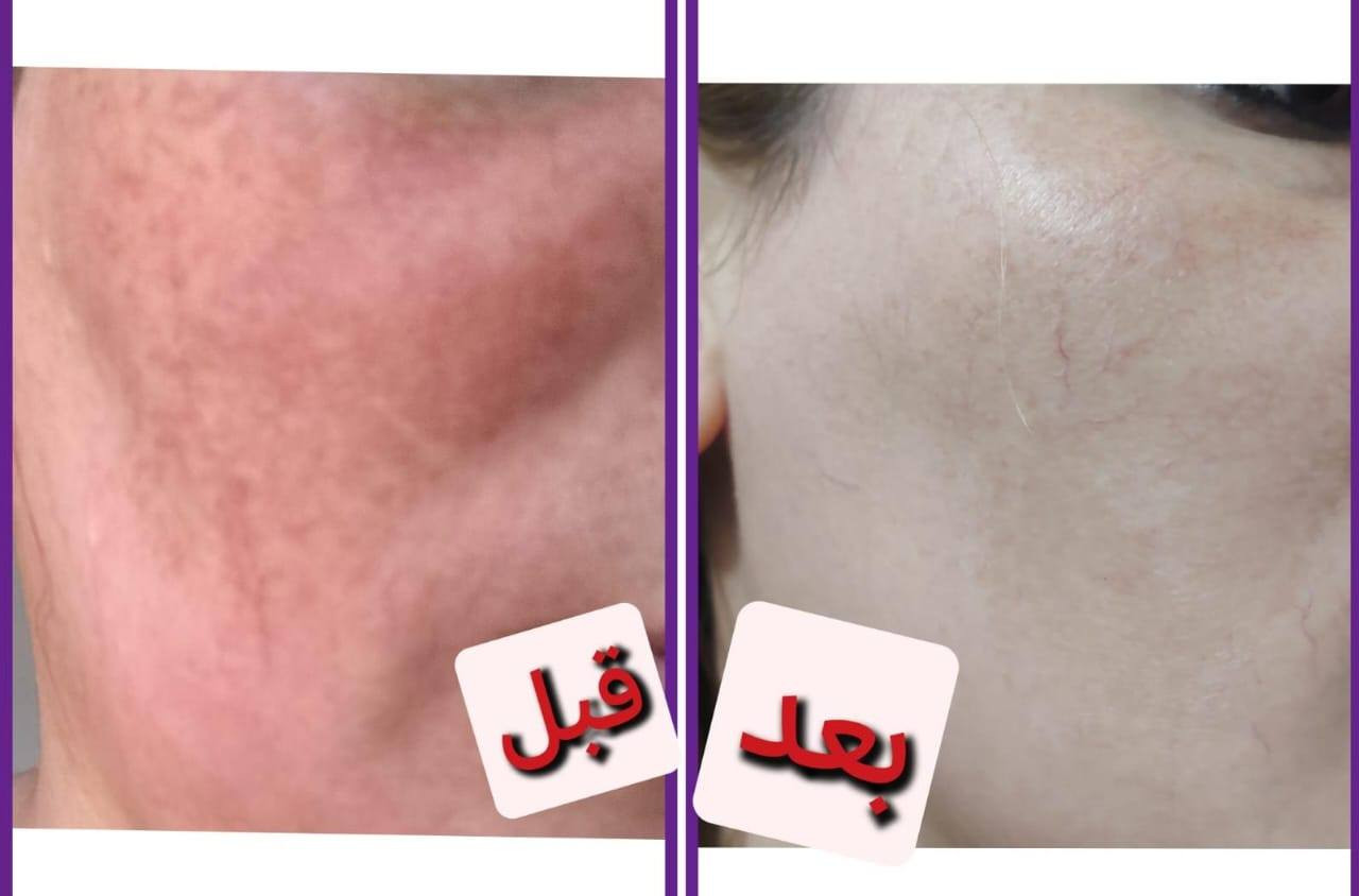 عرض خاص🔥 بمناسبه رآس السنه 
خلطه وصابونه . مع هديه ابره نظاره 🎁 العرض لمده اسبوع.
 سارع بلحجز قبل نفاذ الكميه🏃‍♀️
✅فوائد الخلطه✍️✍️
1⃣تفتيح لون البشرة وتوحيدها، 
2⃣مكافحة البقع الداكنة وعلامات الشيخوخة المبكرة، 3⃣وتقشير البشرة بلطف وإزالة خلايا الجلد الميتة. 
كما يعمل على تهدئة البشرة 
4⃣وتوفيرها بالفيتامينات اللازمة للحفاظ على صحتها ونضارتها،
5⃣ وله خصائص تمنع ظهور حب الشباب.

 الحجز وتساب ***********
