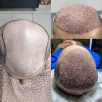 بعض حالات زراعة الشعر  تغطية الصلع كامل (vip)  العرض مستمر تكدرون تحجز...