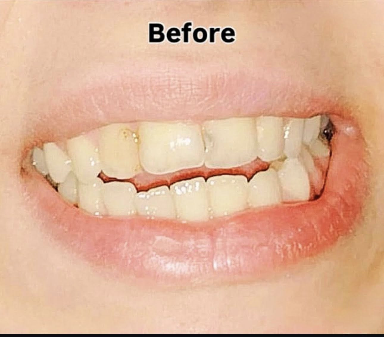 ✨ علاج أسنان مجانًا وبإشراف أطباء اختصاص ✨
السلام عليكم 
• حشوات ضوئية للأسنان الأمامية والخلفية
 • قلع الأسنان المتحركة والتالفة
 • تنظيف وتلميع الأسنان
 • تعويضات جزئية متحركة
 • كل الشغل يتم بإشراف دكاترة اختصاص من الجامعة لضمان أفضل نتيجة

📍 الموقع: جامعة أوروك – كلية طب الأسنان – شارع 52 / الكرادة
📅 المواعيد: يوم الأحد والاثنين
😊 خلي ابتسامتك ترجع بثقة

📞 للتواصل: ***********
