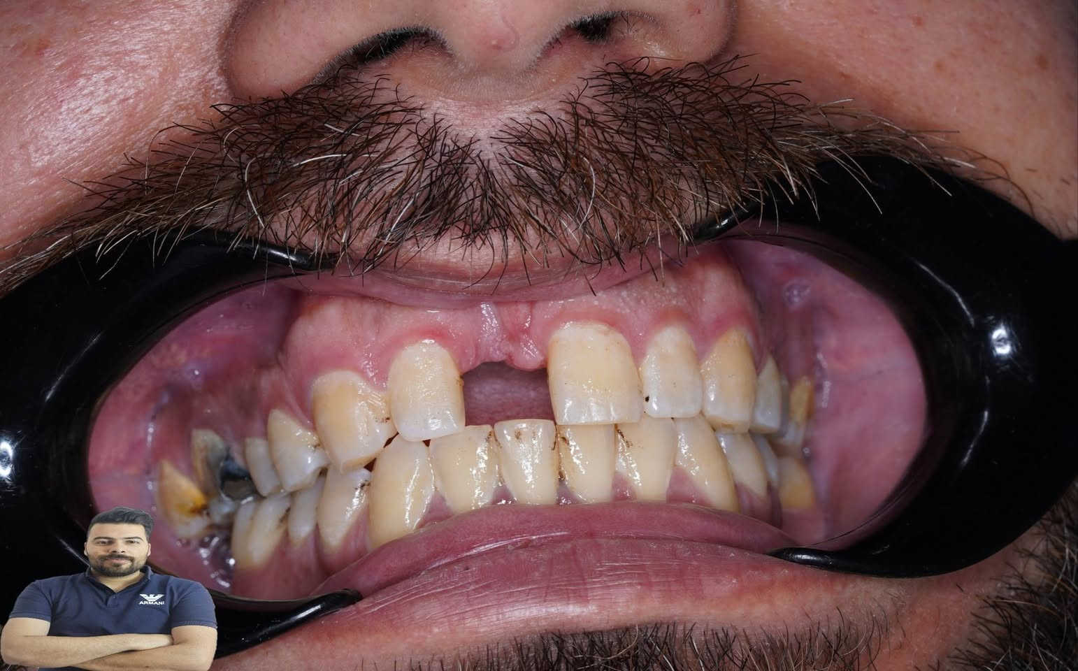 ابتسامة جديدة مراجع يعاني فقدان في سنهة الامامي سوينالة تغليف زاركون بلون مقارب للون الاسنان المجاورة

العنوان / المسيب / شارع البلدية / مقابل دكتور جعفب وفي للاطفال

للحجز والاستفسار
***********
***********
