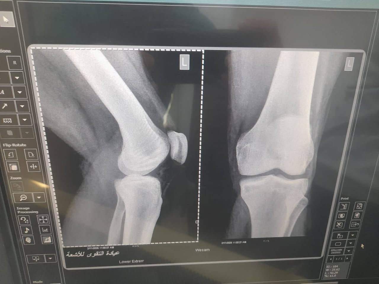 السلام عليكم 
عيادة التقوى للفحص بالاشعه لجميع انواع الكسور والاصابات الرياضيه والمفاصل ولكل اجزاء الجسم الملونه والعاديه 
جهاز CR ,,الحديث 
العنوان الرمادي  ٥كيلو مقابل جامع الشهداء
للاستفسار على الرقم ***********
واتس اب واتصال 
الصحه والسلامه للجميع يارب
