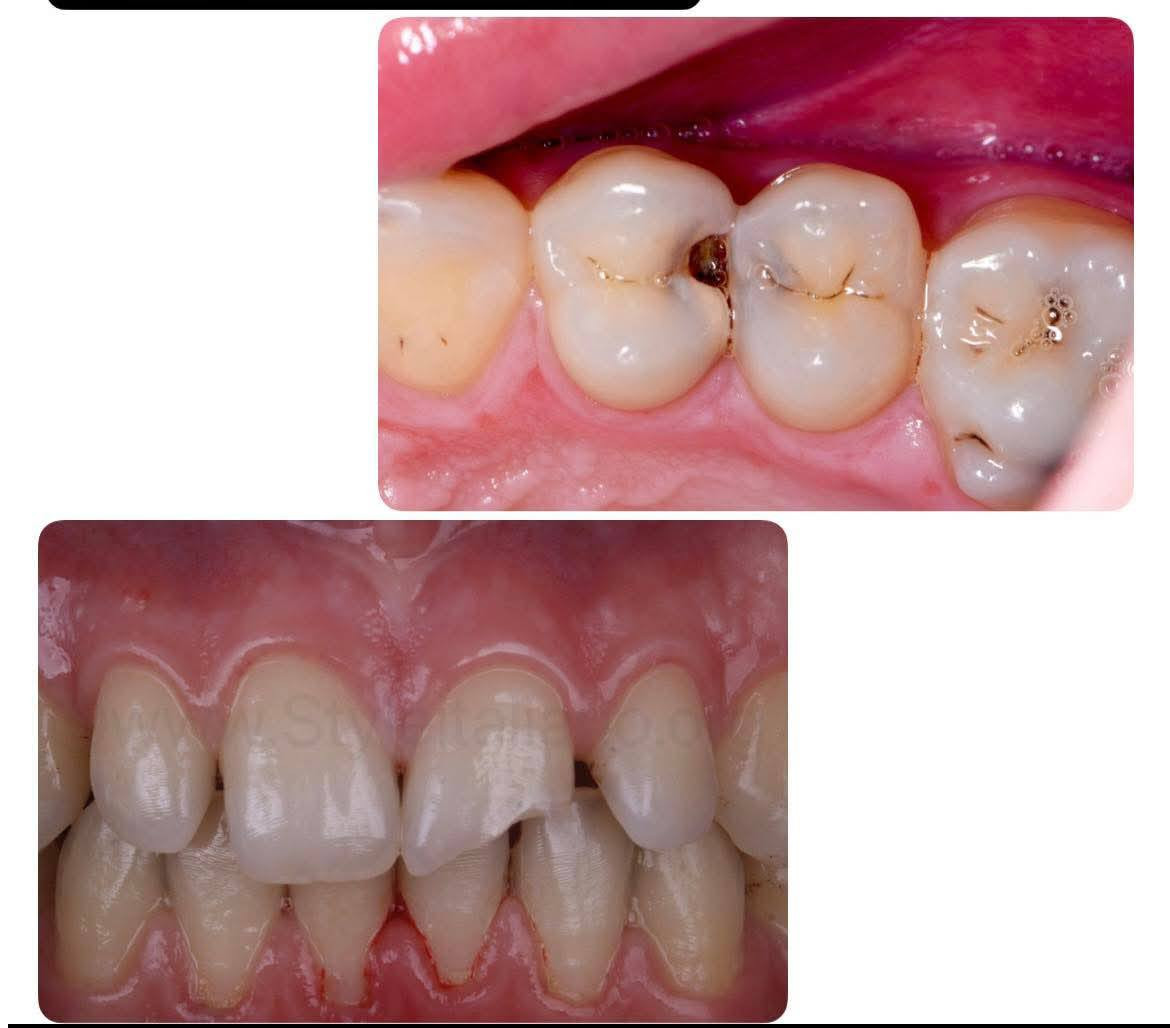 السلام عليكم .
. المحتاج علاج لاسنانه وبشكل مجاني يتواصل ويايه عالخاص
***********على رقم الواتساب. 
 والعلاج يشمل ..
 حشوات ضوئيه 

_قلع الاسنان والجذور التالفه 

تنظيف الاسنان وازالة التكلسات

-عيادة الاطفال التي

 تتضمن(الحشوات-القلع-التنظيف-جلسة فلورايد وقائيه لحماية الاسنان من التسوس 

العنوان الجامعه العراقيه _ الاعظميه
كليه طب الاسنان _قرب المقبرة الملكية

علماً بأن العلاج مجاناً وتحت إشراف أطباء اختصاص
