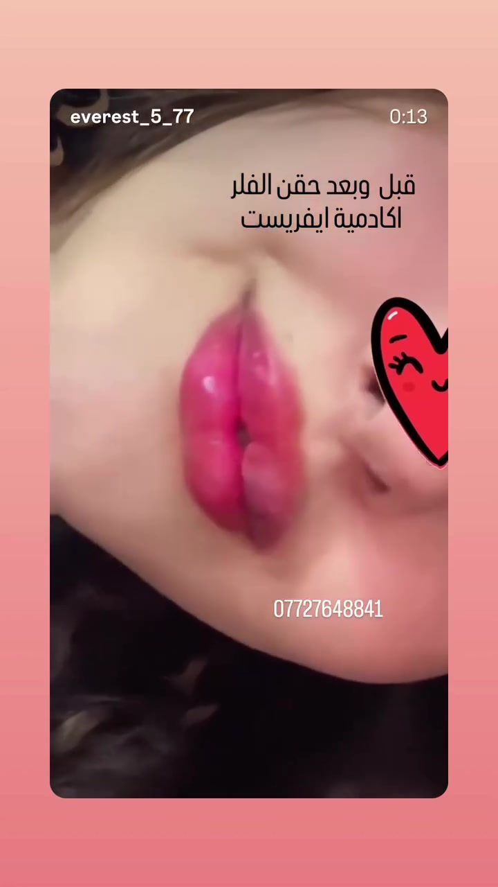 عرزض عيد الاضحى المبارك من اكادمية ايفريست 
تاتو حواجب ٢٠ الف فقط
ازالة تاتو بالا حماض ب٣٠
توريد شفه ٣٠ الف 
فلر شفه ٥٠ الف 
فلر وجه كل ٤ سيسي ب١٥٠ 
بوتكس للجبين وحول العين ب٥٠
بوتكس بتقنية  نفرتيتي ب٥٠ 
تنظيف بشره بجهاز الهايدرو فيشل  مع ابلازمه ب٢٥
ابلازمه فقط ب١٥
تنظيف  بشره فقط ب١٥
ميزو نضاره ب٢٠
شمع وخيط ب١٠
قص الشعر ب ٥
صبغ الشعر والعنايه به بعد المعاينه تتقرر الاسعار 
الليزر 
فل بدي ب ٥٠
واي منطقة ب١٠ 
تركيب الرموش ب٢٠
العنوان بغداد الشعب خلف متوسطة صلاح الدين شارع حسينية الانصار ***********
