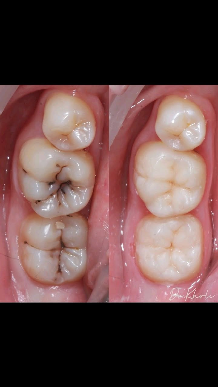 الي يحتاج
قلع 
حشوات 
تنظيف اسنان 
تعويضات سنية 
يتواصل على الرقم:***********
