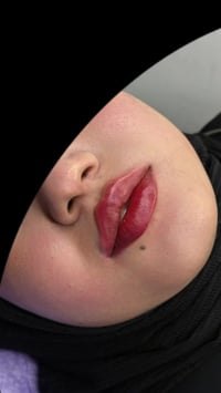 تعديل فيلر • الكوت الهورة • د. ايثار