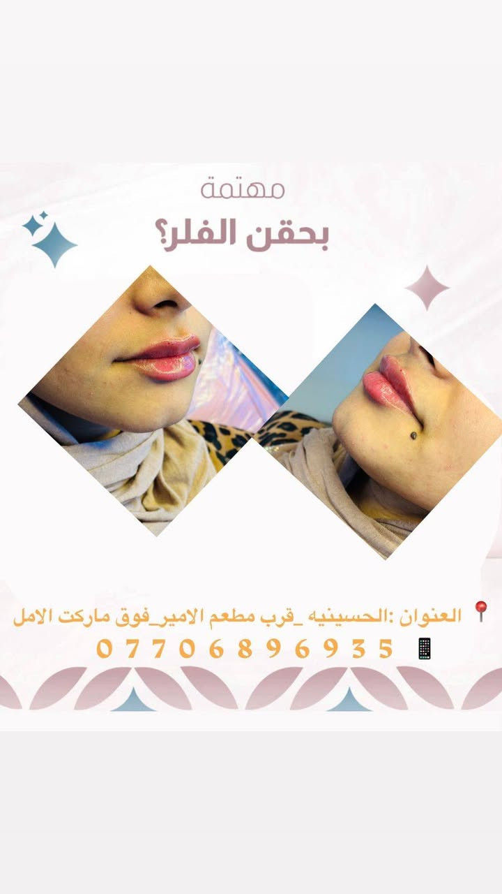 عيادة مصطفى التميمي للتجميل والليزر
لأن جمالك يستحق الأفضل 🌸
فلر _بوتكس _علاج حب الشباب _تقطيع الالياف _علاج تصبغات _سكن كير حسب نوع البشره _تنضيف بشره _ليزر
📍 الحسينية – قرب مطعم الأمير _فوق ماركت الامل _مجاور مطعم عمو باسم 
📞 ***********
عنوان الثقة والجمال الحقيقي ✨
خبرة، دقة، واهتمام بأدق التفاصيل
باستخدام أحدث الأجهزة وأفضل المواد
للحصول على نتائج طبيعية وآمنة 💎
نعتني ببشرتك حسب نوعها
ونقدّم حلول متكاملة للتجميل والعناية
جميع المواد المستخدمه داخل العياده مفحوصه وبراندات 
تنفتح كدام المراجع
