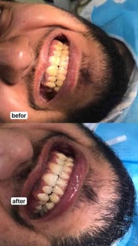 اي شخص عنده بقايا جذر او سن منتهي ويريد يقلعه او عنده تسوس ويريد يسوي ...