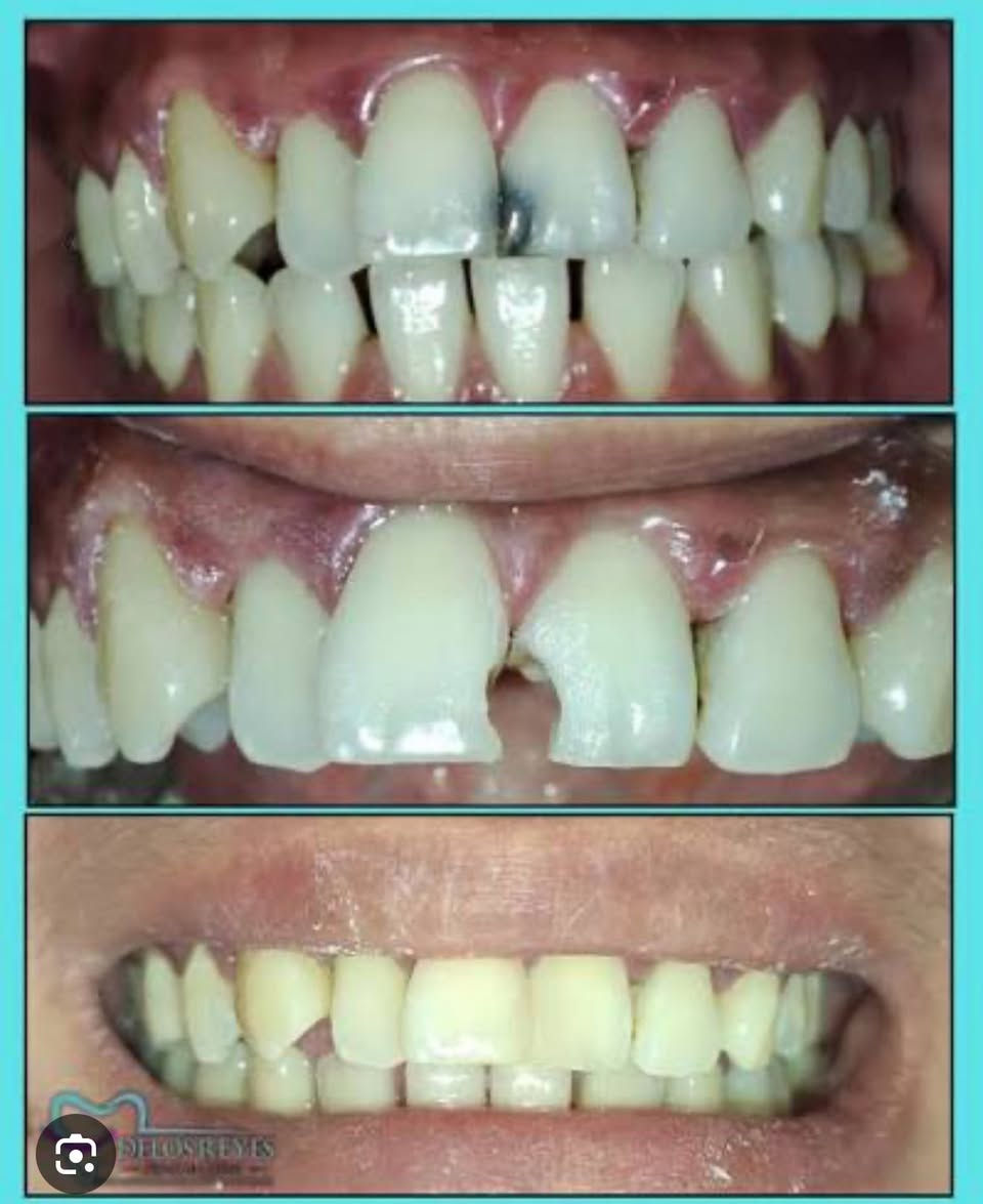 مجاناً 🔴
العنده هيج تسوسات يتواصل ع رقم  
***********
