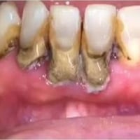 تنظيف اسنان • قلع اسنان • مجاني بالجامعة