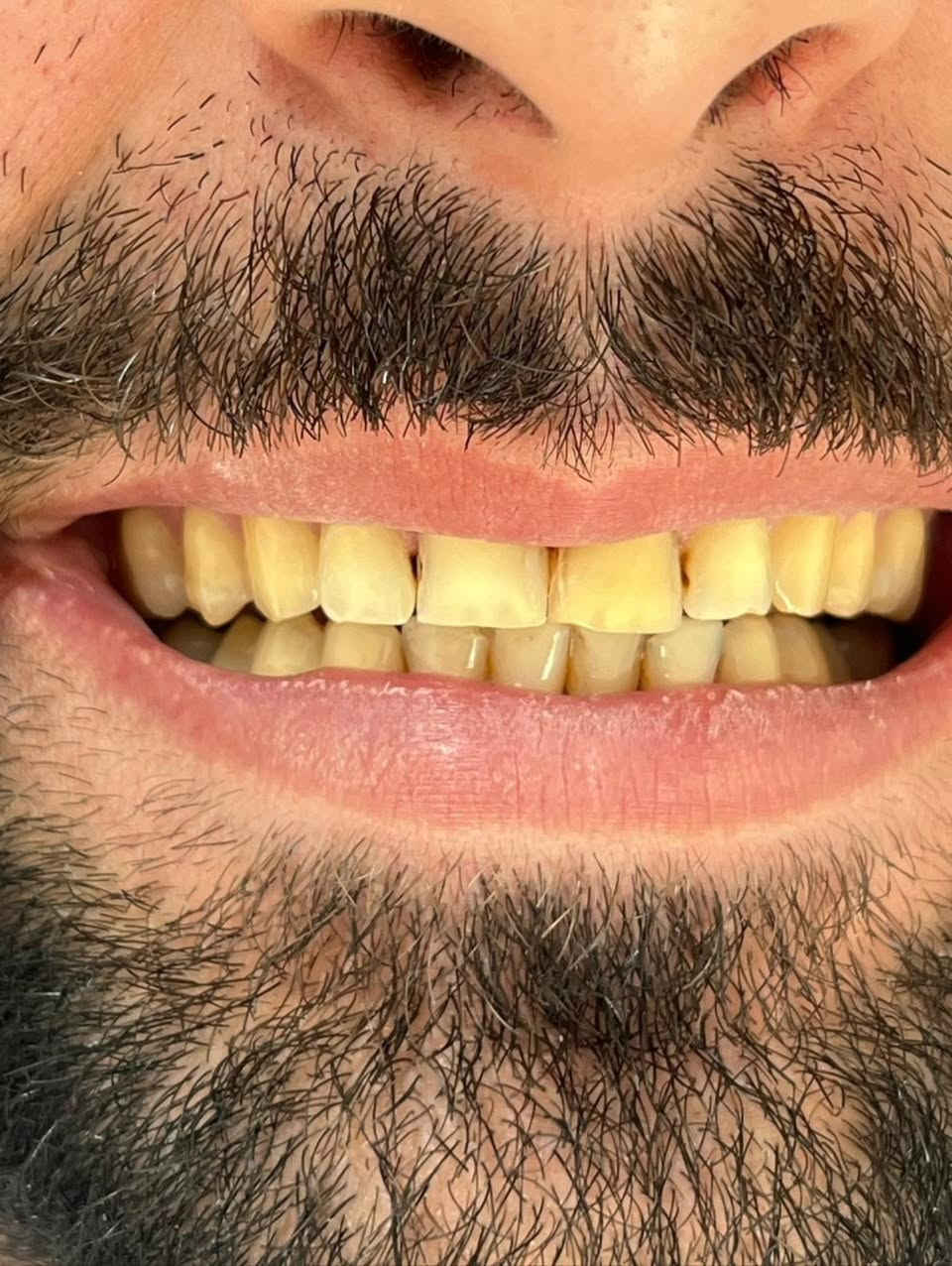 "🦷 أسنان صحية وابتسامة مشرقة...

في مراكز الشركة الطبية العالمية ، نوفر لك أحدث تقنيات طب الأسنان، وأسهل طرق الدفع.

✅ تقويم الأسنان ✅ تبييض الأسنان ✅ ابتسامة هوليوود
زراعة أسنان 
وحشوات وكتير من الخدمات 

متواجدين داخل المركز طيلة أيام الأسبوع لخدمتكم 

  #عيادة_اسنان #طب_اسنان #كي_كارد #KeeCard #دفع_الكتروني تقويم_اسنان تبييض_الاسنان زراعة_الاسنان ابتسامة جمال صحة

العنوان : طويريج _الشارع العام_مجاور نقابة المعلمين _مقابل المكتبة العامة _مجمع الحارث الطابق الثاني 

رقم الهاتف ***********
                ***********

