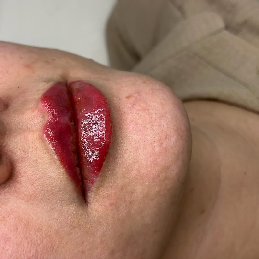 ✨تكبير وتحديد الشفاه بشكل ناعم وطبيعي
تصحيح عدم التناسق بين الشفة العليا والسفلى
ترطيب الشفاه ومنحها مظهراً شاباً
نتائج فورية مع فترة تعافٍ قصيرة
✨النتيجة مباشرة 
الحجز التواصل ***********
العنوان :.بغداد المنصور الداودي
