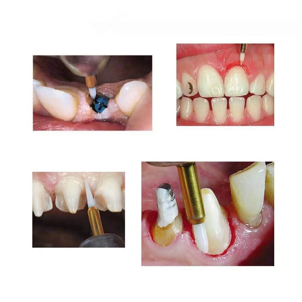 يعلن مكتب تاج الخيرات لتجارة مستلزمات طب الاسنان عن توفر  : 

بير قص اللثة السيراميكية - Soft Bur (Tissue Trimming Bur / Ceratips)
من شركة Microdont

 
. بير مصنوع من ماده السيراميك وليس الستيل
.يستعمل لقص اللثه بدون ميصير Bleeding 

بسعر مناسب جداً 😍

عدد 1

 
للطلب والاستفسار: 

📩مراسلة الصفحة خاص 

https://www.instagram.com/m.alkhairat26?igsh=MW5vNGxnYnVpd3ZkOQ%3D%3D&utm_source=qr

https://www.facebook.com/share/1BtSMRbtbU/?mibextid=wwXIfr

☎️ او التواصل على الرقم

‏مراسلة مكتب تاج الخيرات عبر واتساب. wa.me/9647814036513

📍باب المعظم 
يتوفر توصيل لجميع أنحاء العراق🚛

د. منار
