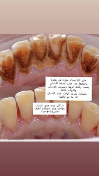 تنظيف اسنان • مجاني • جامعة الحلة