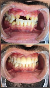 تعويض اسنان • زراعة اسنان • ابتسامة طبيعية • طب اسنان • تجميل اسنان • ...