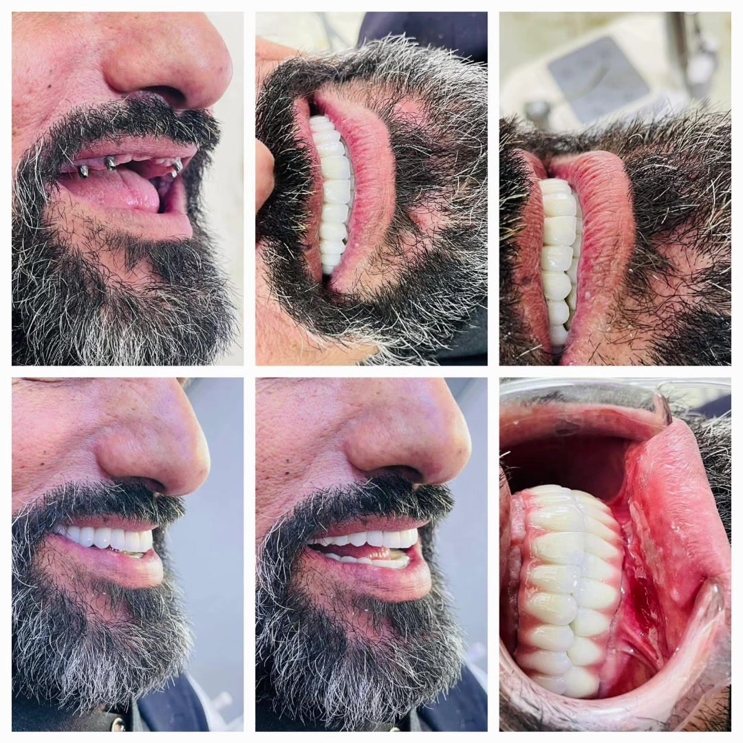 🦷 زرعات أسنان بأفضل المناشئ العالمية

نقدّم لكم أحدث تقنيات زراعة الأسنان باستخدام أجهزة متطورة من شركات عالمية 

🔹 Bien-Air (سويسري – جودة ممتازة)
🔹 Saeshin (كوري – أداء قوي وسعر مناسب)
✅ زرعات أصلية ومعتمدة
✅ بدون ألم وبأحدث الأجهزة
✅ نتائج طبيعية وثابتة تدوم لسنوات
✅ متابعة دقيقة بعد الزراعة
💡 نستخدم أجهزة جراحية متخصصة بزراعة الأسنان بدقة عالية وعزم مضبوط لضمان أفضل النتائج �
wh.com +1 # # @ #
📍 بغداد
📞 ***********
✨ ابتسامتك تستحق الأفضل… احجز الآن!
بأيدي افضل الاخصائيين د. حسن علوان ضيا#🦷 زرعات أسنان بأفضل المناشئ العالمية
زراعة#الاسنان #
