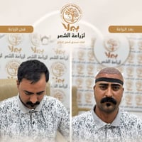 زراعة الشعر • قبل وبعد • بيرلا النجف