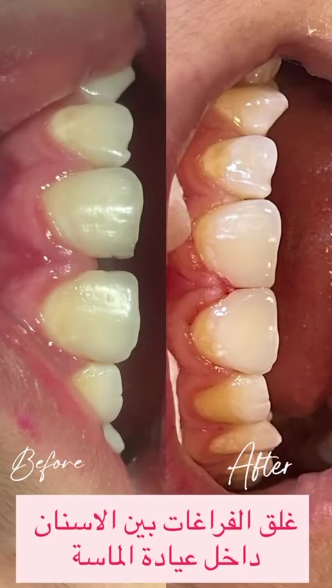 عيادة الماسة لطب وتجميل الاسنان
العنوان الرمادي ـ جويبة  
للحجز والاستفسار:
***********
 #اسنان #عيادة #عيادةـالماسة #طبـاسنان #الرمادي #جويبة
