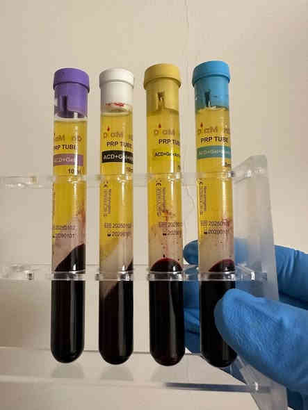 عروض عيادتنا – بسمايـة

يا جماعة… نستفتح مشروعنا بحضوركم الكريم
عدنا فحوصات طبيه مجانيه 
تحاليل مجانيه
اشعه مجانيه
وكذلك التحاليل العامه لفحص كل الجسم ١٥ الف
كذلك الفحص ال

فحص الدم

• وطانف الكلى

- وطائف الكبد

١- الكولستبرول والدهون

- الفيروسات الكبد الوباني

- الغدة الدرقية

- فيتامين د

- فيتامين ب 12

- مخزون الحديد

• مقاس الالتهاب
كذلك عروض مجانيه لعياده التجميل
بقرعه تتم داخل العياده
، والقرعة تصير قدّامكم داخل العيادة حتى محد يكول “ماكو عداله”.

هدايـا مجانية تشمل:

جلسات بوتوكس
جلسات نضارة
جلسات مثبت بياض دائمي
جلسات تكسير دهون
فحص أسنان + أشعة مجاناً

ليش عيادتنا غير؟

أول عيادة ببسمايـة تشتغل بـ الذكاء الاصطناعي + روبوتات استقبال

يعني أنت تجي، الروبوت يستقبلك، وإحنا نعالجك…

عروض الأسنان

ابتسامة هوليوود E-max
السعر الطبيعي 20,000
عرضنا: 950,000 دينار فقط
(إي نعم… السعر يدوّخ، بس مضبوط)

عروض الليزر والعناية

ليزر إزالة شعر Full Body: 35 ألف
جلسات نضارة: 5 آلاف
تفتيح: 5 آلاف
إزالة تصبغات: 5 آلاف
توريد: 5 آلاف
شدّ البشرة: 5 آلاف
إزالة كلف دائمي + ضمان: 65 ألف
مع إبر تثبيت بياض
تقشير المناطق الحساسة: 15 ألف
تفتيح الأكواع: 10 آلاف
الركب: 10 آلاف
جلسة “التغيير الشامل”: 150 ألف

جلسات متقدمة

شد الوجه الجراحي بدون جراحة
إزالة تجاعيد بشكل دائمي
جهاز Accelerator لإزالة الشعر النهائية
يعني… ماكو مراجعات ولا ادامة بعد هاليوم

للحجز والاستفسار

***********
‭+٩٦٤ ٧٧٨ ٠١٧ ٧٩٥٥‬ 

نورونا وباركوا رزقنا… رزق حلال وبخدمة أهل بسمايـة.
