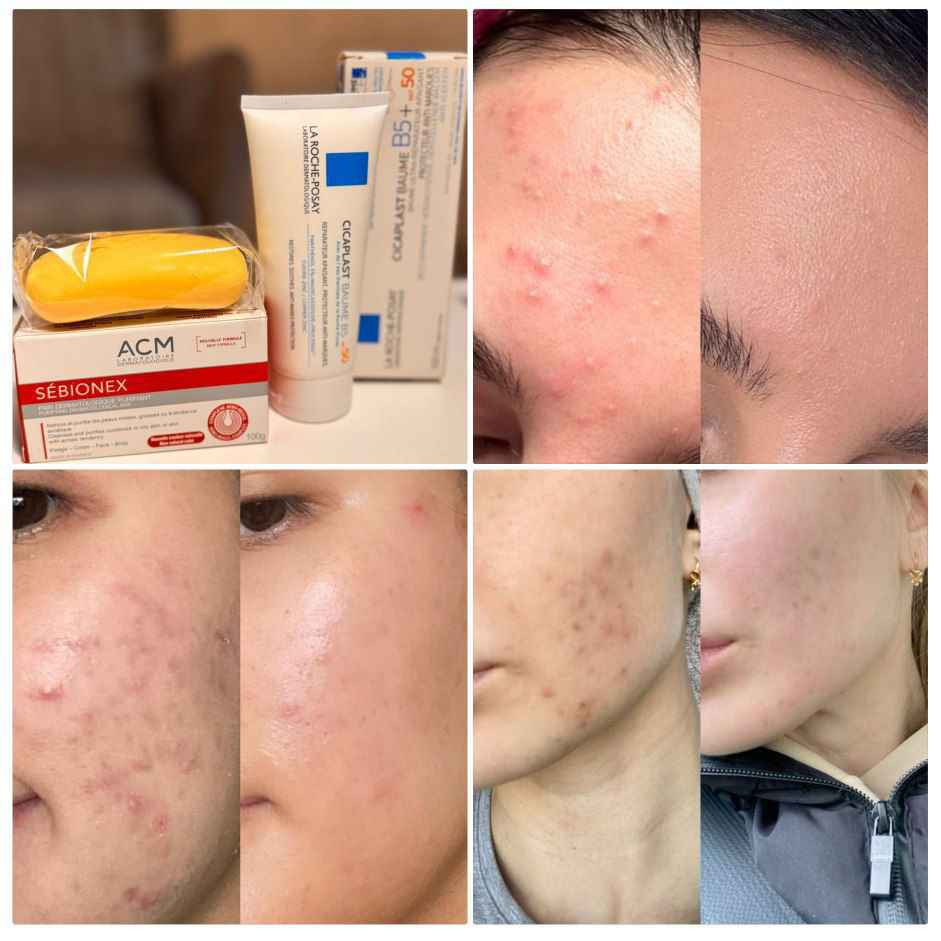 ✨ باكج تنظيف وتهدئة البشرة ✨

إذا تعانين من حبوب، دهون أو مسامات واسعة بالبشرة

هاي المجموعة راح تعطي بشرتك عناية متكاملة 😍

✔️ صابونة سيبيونيكس ACM
تنظيف عميق، تقلل الدهون والشوائب وتساعد على تقليل حجم المسامات

✔️ سيكابلاست B5 من لاروش بوزيه

يرمم البشرة ويهدئ الاحمرار والتهيج، ويخلي البشرة أكثر نعومة ونضارة

مثالية للبشرة الدهنية والحساسة
تخلي البشرة أنظف، أهدأ وأكثر نضارة ✨

📩 للطلب والاستفسار راسلينا خاص
الكمية محدودة 🔥

السعر 28
👈🏻💌اي استفسار او الحجز👇🏻

***********
#التوصيل مجاني 
#لجميع بغداد, العراق
