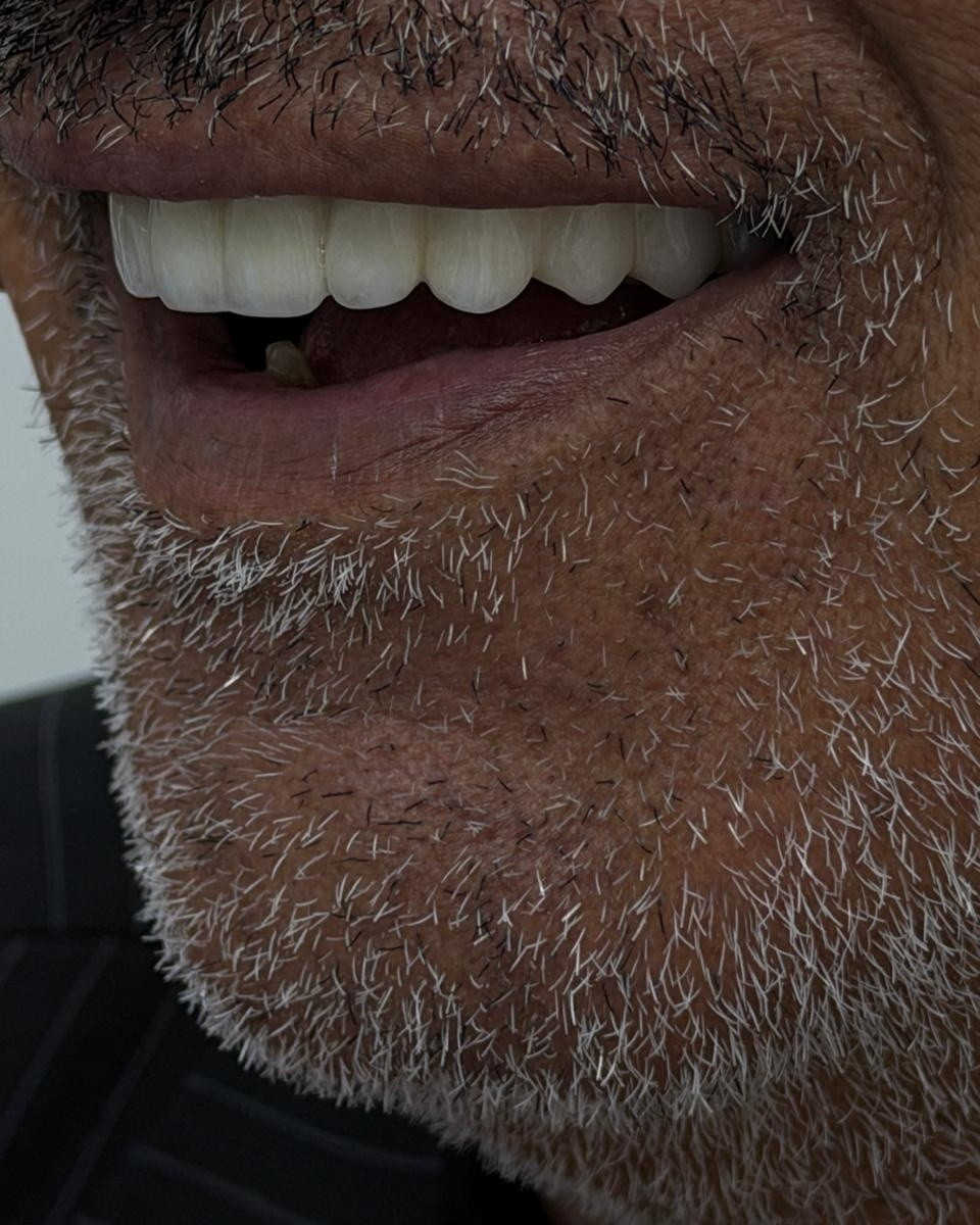 نحن لا نغير هويتك، بل نكشف عن النسخة الأجمل منك؛ في مركز الوارث، نبتكر لك إشراقةً خاصة تتحدث عن ثقتك قبل أن تنطق بكلمة 
من اعمال طبيبنا المتميز🫡
د محمد السخي
📍 متواجدين يومياً طول أيام الأسبوع:
⏰ من الـ9 الصبح للـ12 الظهر
⏰ ومن الـ2:30 العصر للـ9:30 بالليل

📞 للتواصل ويانه:
✅ العيادات البشرية: ‎***********
✅ عيادات التجميل: ‎***********
✅ عيادات الأسنان: ‎***********

📍 العنوان: الناصرية – شارع بغداد، مجاور مدرسة الجواهري الأهلية
