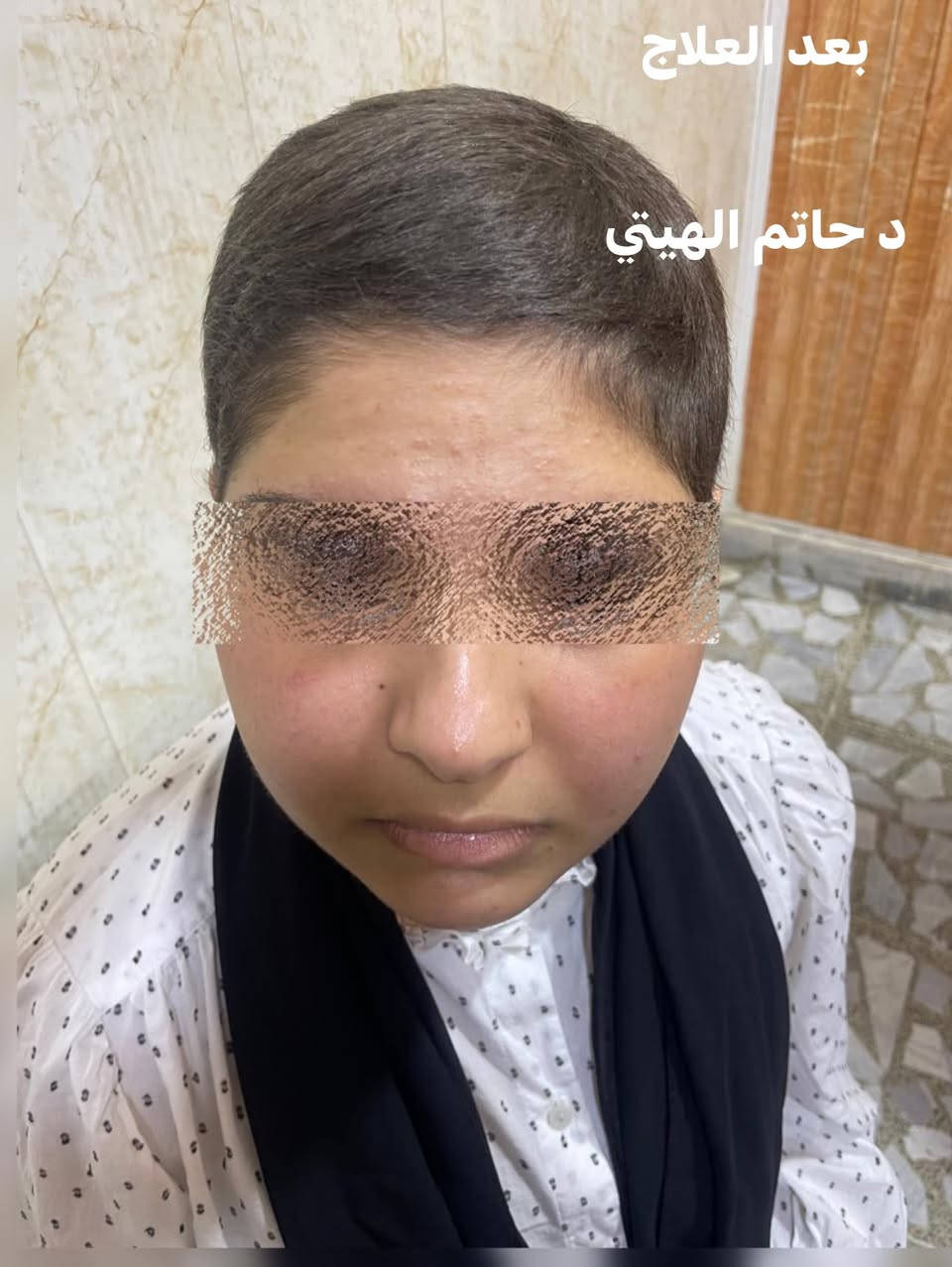 مريضة تعاني من داء  الثعلبه
وهذه الصور قبل وبعد
تمت المعالجه على يد الدكتور حاتم الهيتي
اخصائي الجلدية والتناسلية والعقم
مجمع جنان الملكي
شارع المستودع مقابل مطعم ام تي
الدوام طيله ايام الاسبوع
رقم الحجز 
 

***********

